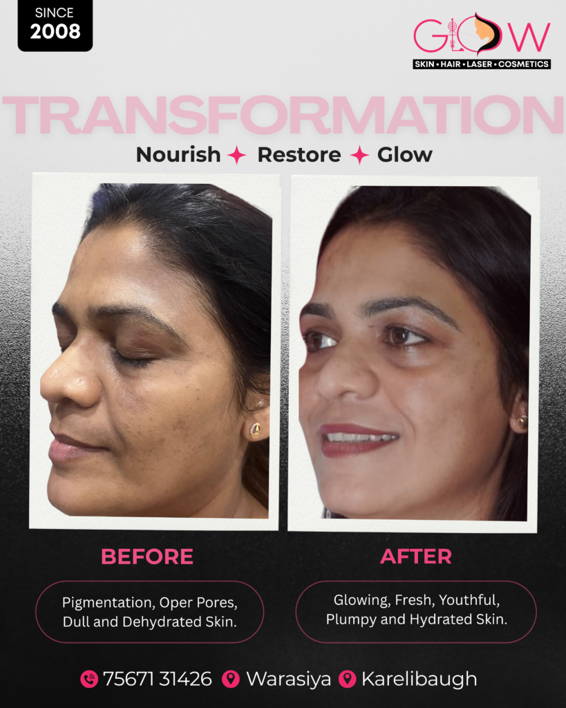 Pigmentation Treatment Vadodara at Glow Skin Clinic