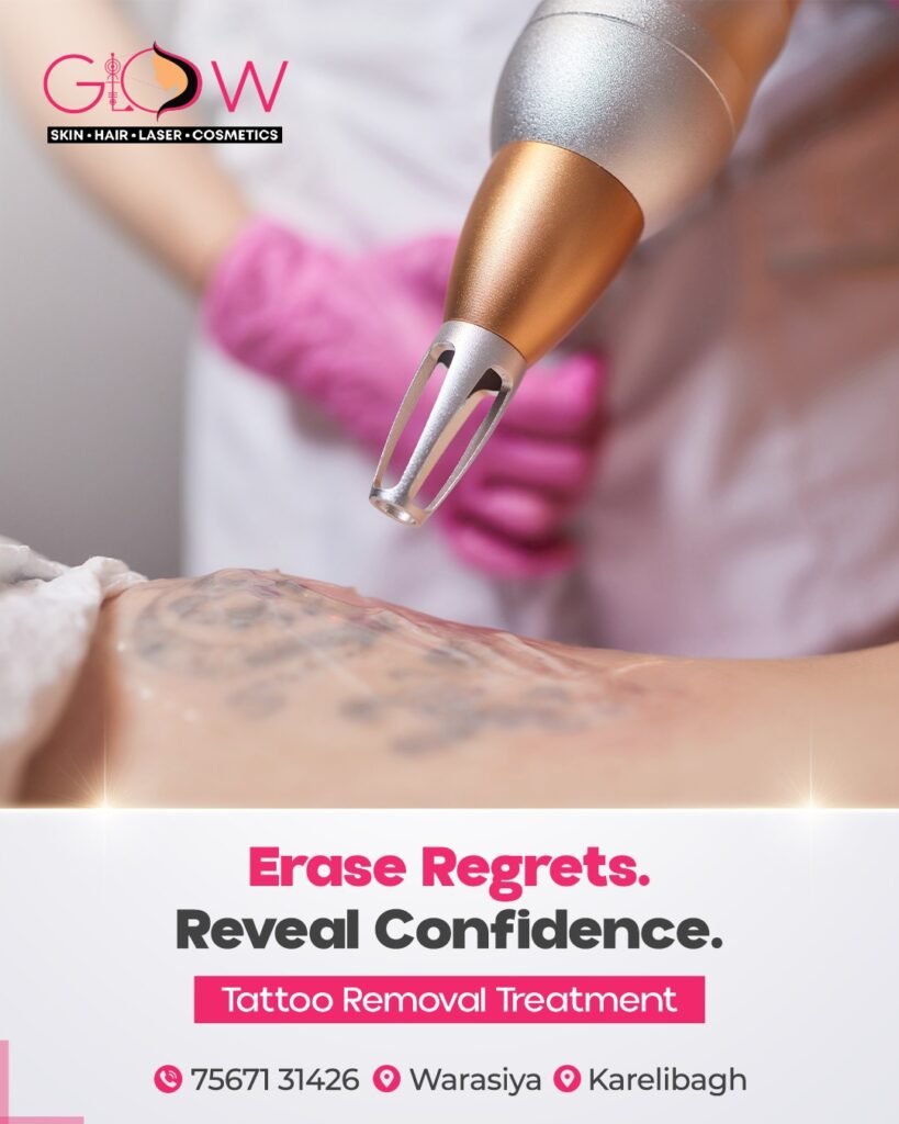 Tattoo Removal Vadodara at Glow Skin Clinic