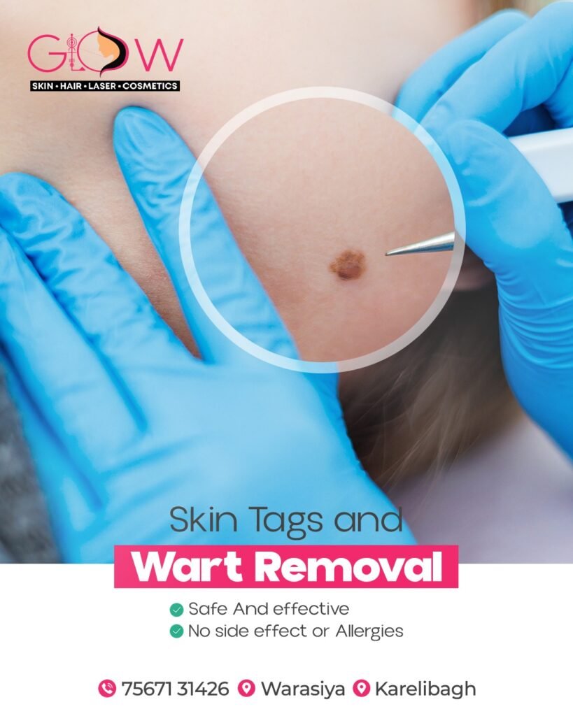 Wart Mole Removal Vadodara at Glow Skin Clinic