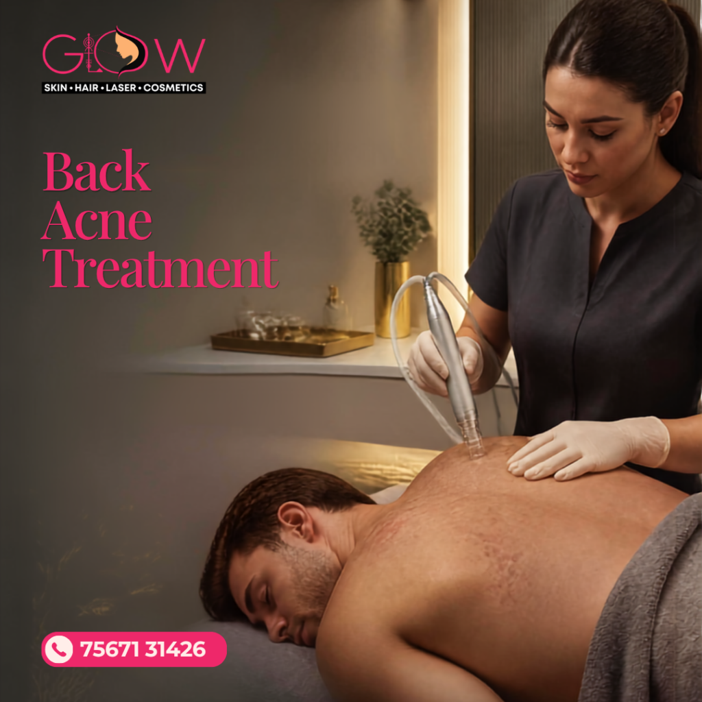 Back Acne Treatment Vadodara at Glow Skin Clinic