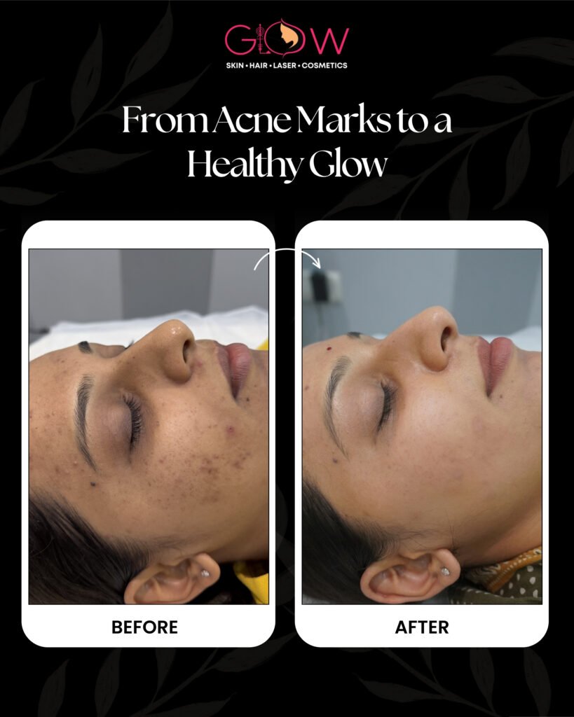 Acne Scar Removal Vadodara at Glow Skin Clinic