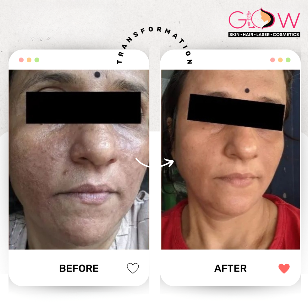 RF Skin Tightening Vadodara at Glow Skin Clinic